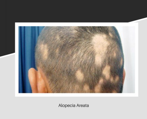 The effects of Alopecia Areata