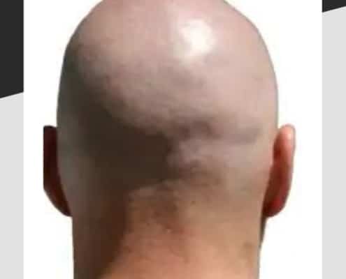 No hair to protect the skull
