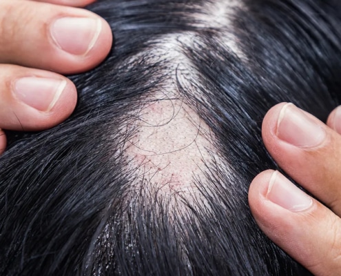 Alopecia Areata
