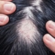 Alopecia Areata