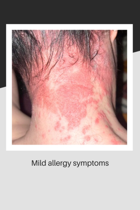 Reddening of skin on nape after allergic reaction to hair treatment