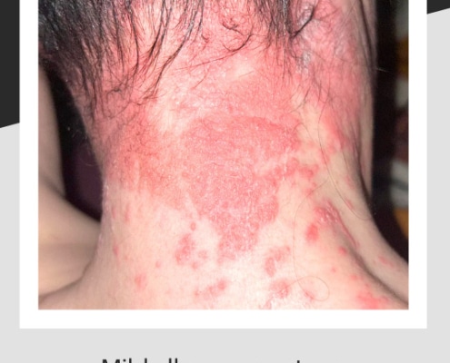 Reddening of skin on nape after allergic reaction to hair treatment