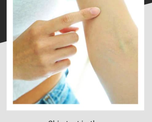 Picture showing crook of the elbow is the bets place for a skin test