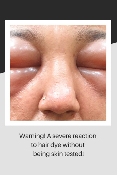 A severe reaction to hair dye on a woman's face