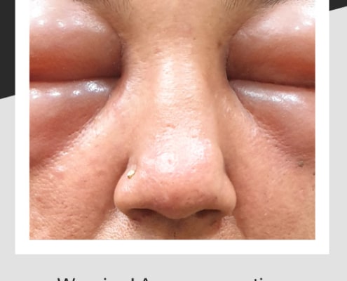 A severe reaction to hair dye on a woman's face